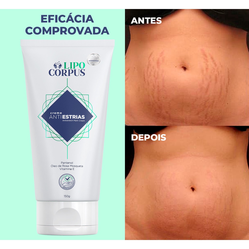 Creme para Estrias Lipo Corpus